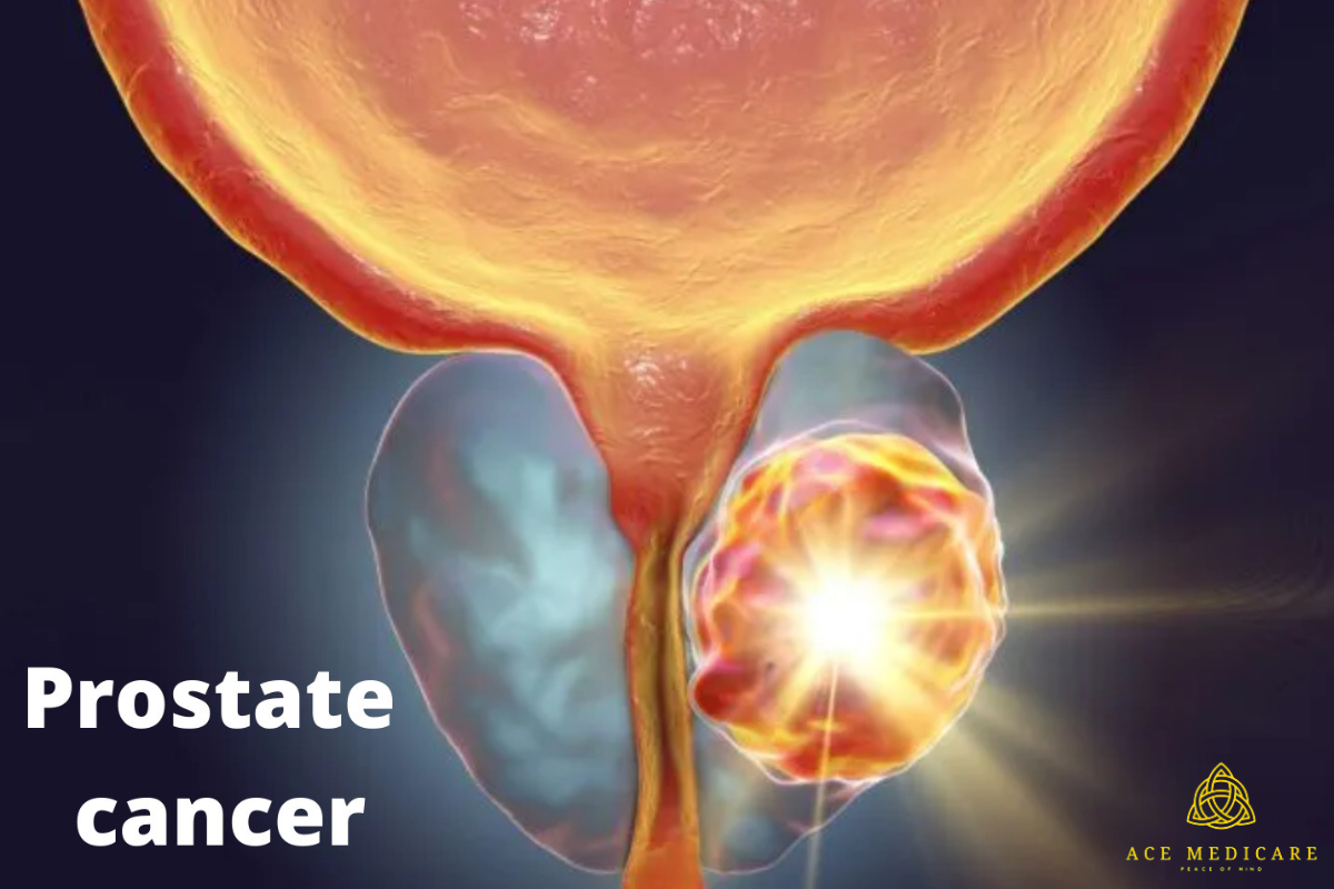 The Silent Threat: Unveiling the Facts about Prostate Cancer